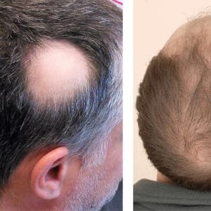 Hair Vitamins For Men: Which Should You Take? - Wimpole Clinic