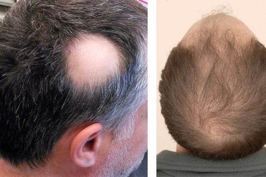 Hair Vitamins For Men: Which Should You Take? - Wimpole Clinic